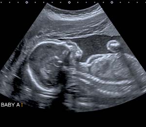 scan of baby in womb